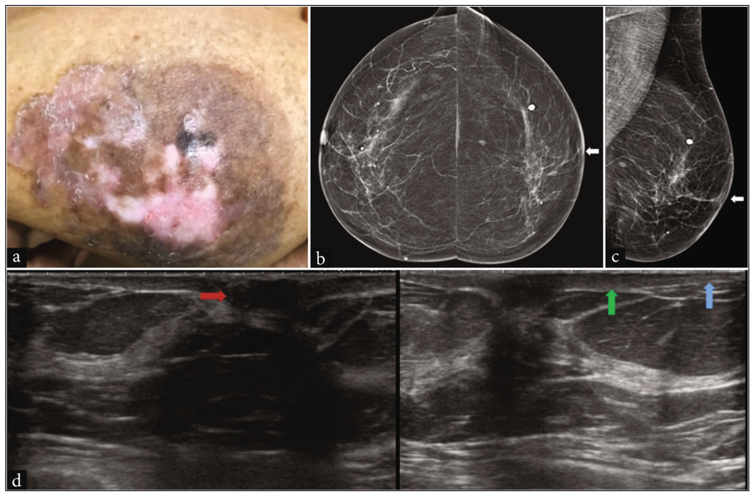 Paget’s disease of the nipple without any abnormal mass or microcalcification in the breast parenchyma in a 62-year-old woman presented with complete erosion, discoloration of the left breast nipple with mild ulceration of the skin. (a) Clinical picture demonstrating the visible changes. (b) Digital mammogram, Craniocaudal view showing erosion of left nipple and mild thickening of nipple areolar skin (white arrow). (c) Mediolateral oblique view of left breast showing complete erosion of left breast nipple (white arrow). (d) High-resolution ultrasound of the left breast revealed a hypoechoic lesion in the nipple region with acoustic shadowing (red arrow), thickened skin of the nipple-areolar complex (green arrow), and normal skin of the rest of the breast (blue arrow).