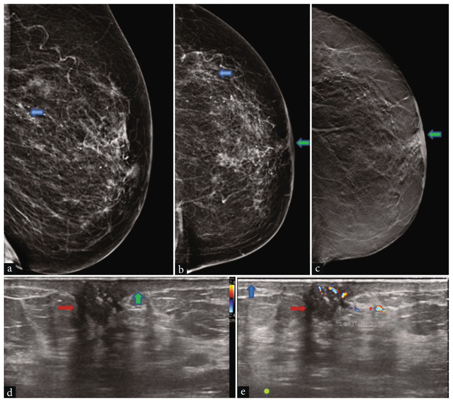 Case of Paget’s disease with DCIS in a 60-year-old woman. Digital mammogram of the left breast (a) Mediolateral oblique, (b) Craniocaudal view, and (c) tomosynthesis image revealed microcalcification scattered in the breast (blue arrows). Erosion of the left nipple and thickening of the nipple areolar skin are seen more clearly on tomosynthesis images (green arrows). (d and e) High-resolution ultrasound and color Doppler of the left breast revealed a hypoechoic lesion in the nipple region with vascularity and acoustic shadowing (red arrows), thickened skin of the nipple areolar complex (green arrow), and normal skin of the rest of the breast (blue arrow). DCIS: Ductal carcinoma in situ.