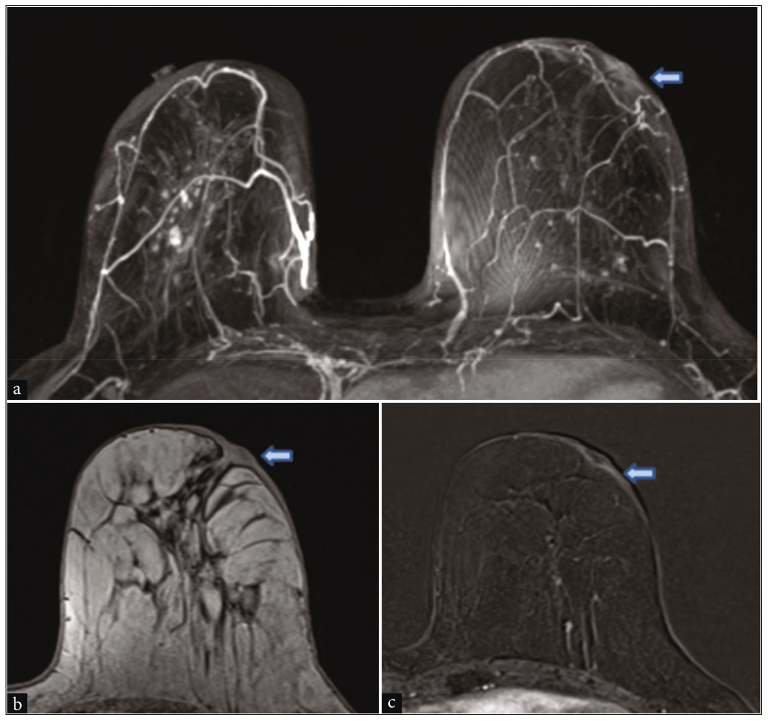 Dynamic contrast-enhanced MRI. (a) Dynamic contrast-enhanced MRI axial maximum intensity projection revealed erosion of the left breast nipple with thickening of the overlying skin of the nipple areola (blue arrow). Right side nipple showing normal enhancement. (b) Axial T1WI without fat-suppressed image showing thickening of the skin (blue arrow). (c) Post-contrast subtracted image showing mild enhancement of the nipple areolar region (blue arrow).