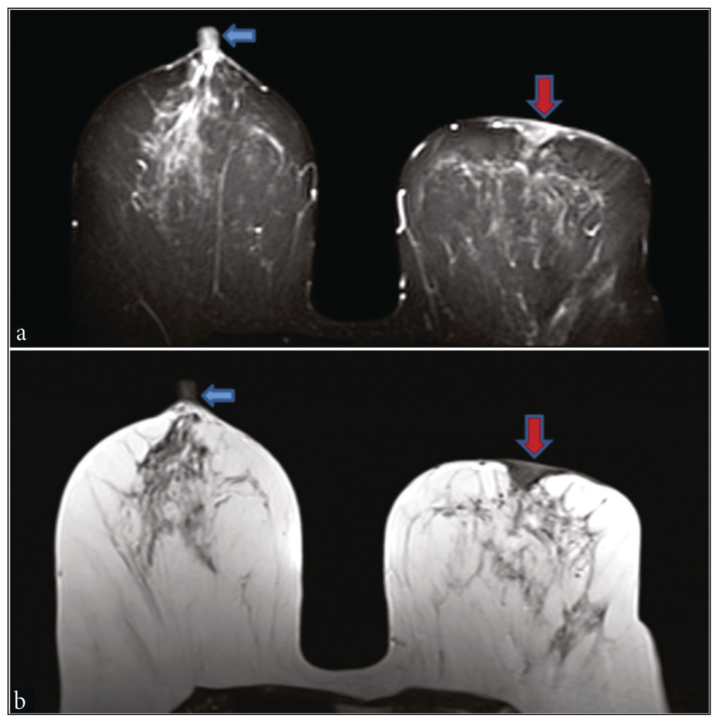 Case of Paget’s disease. (a) Short tau inversion recovery axial MRI revealed erosion of the left breast nipple and edema in the nipple areolar region (red arrow), and the right side nipple was normal (blue arrow). (b) Non-fat suppressed axial T2WI image showing erosion and thickening of skin over left nipple (red arrow); right nipple is normal (blue arrow).