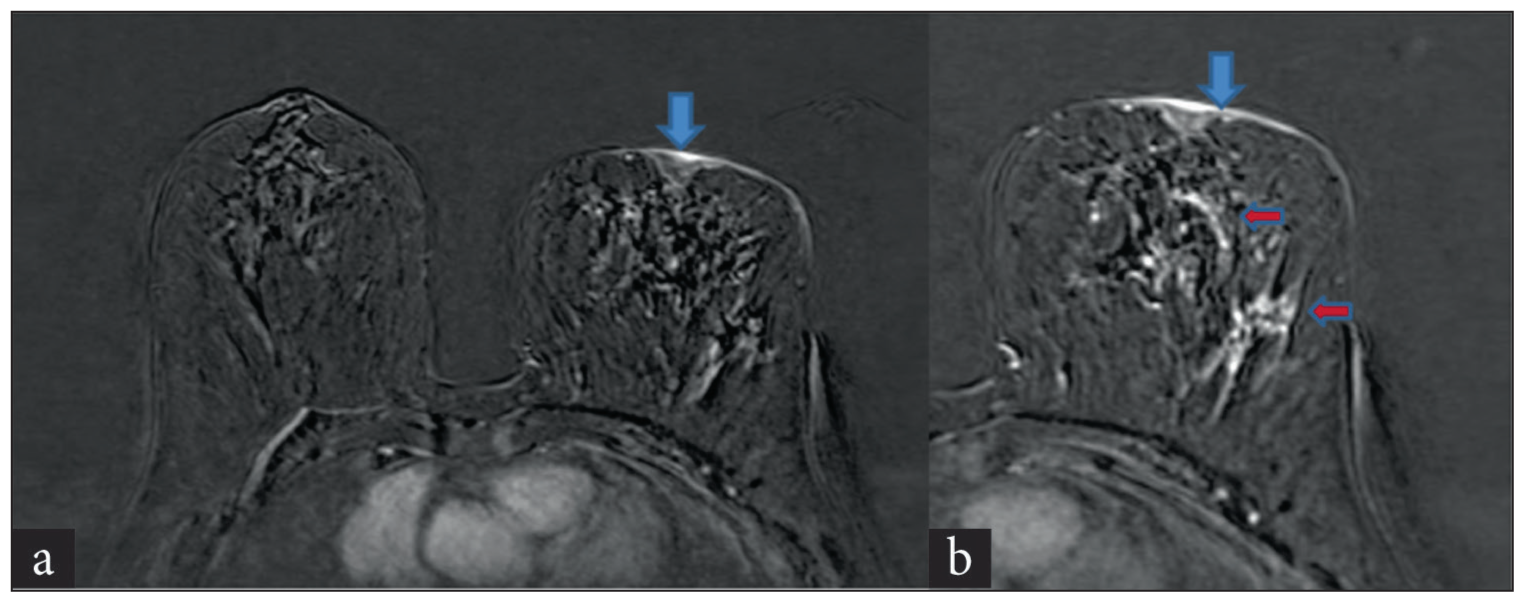 (a) Case of Paget’s disease with DCIS—dynamic contrast-enhanced MRI revealed erosion of the left breast nipple and abnormal enhancement in the nipple areolar region (blue arrow), with the right side nipple showing normal enhancement. (b) Erosion of nipple and abnormal enhancement (blue arrow), few areas of non-mass enhancement seen in breast parenchyma (red arrows). DCIS: Ductal carcinoma in situ.