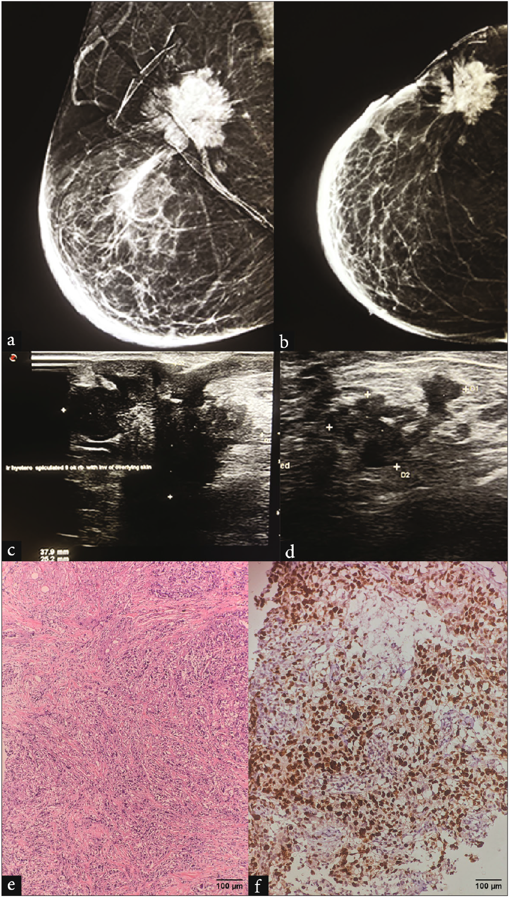 A 38-year-old female presented with a palpable lump in the right breast in the upper outer quadrant. (a-b) MLO and CC view of mammogram of right breast reveal An irregular high-density mass with spiculated margins and associated skin retraction and invasion. Diffuse skin and trabecular thickening noted secondary to lymphatic obstruction. (c) Corroborative grayscale ultrasound shows an irregular heterogeneous mass with spiculated margins and shadowing. (d) USG of the ipsilateral axilla revealed irregular level I lymph node with extracapsular breach. (e) H&E, 20x: grade 3 invasive breast carcinoma, NST. (f) Ki67 labeling index: 70%–80%, grade 3 IBC, NST. MLO: Mediolateral oblique, CC: Cranio caudal, USG: Ultrasound, H&E: Hematoxylin and eosin, NST: Non specific type.