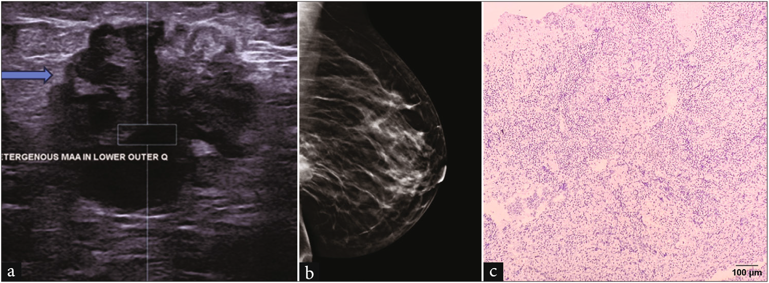 A 33-year-old woman who presented with a palpable lump in the left breast. (a) Grayscale USG image of the left breast shows an irregular shaped, heterogeneous, anti-parallel mass with microlobulated margins (blue arrow) and posterior enhancement. (b) Tomosynthesis slice showed a partially visualized high-density irregular mass in the posterior third of the breast. (c) H&E, 20x: ER/PR: negative (Allred score 0/8), HER2Neu negative in grade 3 carcinoma was found on core needle biopsy of the lump in the above patient. USG: Ultrasound, H & E: Hematoxylin and Eosin, ER: Estrogen receptor, PR: Progestreone receptor.