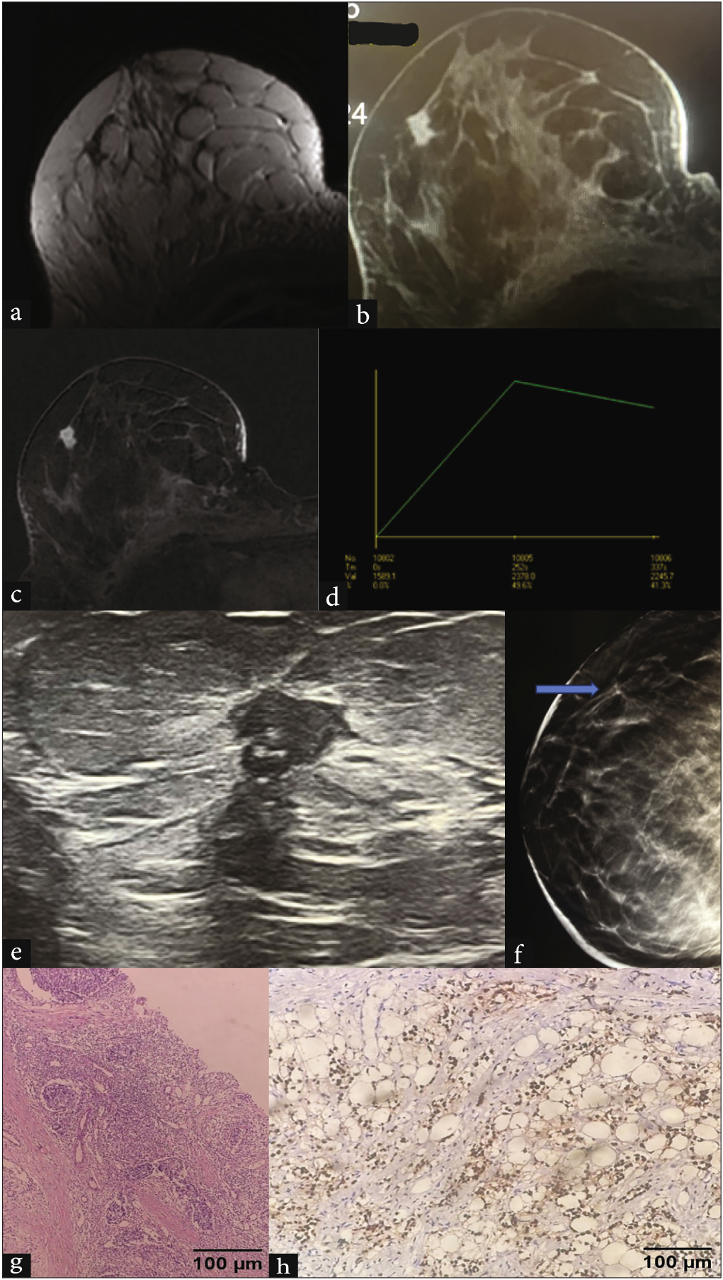 Vague pain as presentation in 39 year old female: Dynamic contrast enhanced MRI revealed an irregular spiculated mass in upper outer quadrant of right breast which was hypointense on (a) T2 and showed heterogeneous enhancement on (b-c) post contrast images with (d) type III kinetic curve. (e) The corroborative USG showed mass as irregular, non-parallel, heterogeneous, spiculated and with no posterior features. It was seen as an area of architectural distortion better appreciated on (f) tomosynthesis. (g) Biopsy confirmed it as invasive ductal carcinoma, NST. H&E, 20x: Photomicrograph showing nests and sheets of tumor cells exhibiting marked nuclear pleomorphism, enlarged nuclei with vesicular chromatin, and increased mitosis—grade 3 invasive breast carcinoma, NST. (h) IHC for ER and PR, 10x: shows ER+/PR+ (Allred score 5 + 3 = 8). MRI: Magnetic resonance imaging, USG: Ultrasound, H&E: Hematoxylin and eosin, IHC: immunohistochemistry, NST: Non specific type, ER: Estrogen receptor, PR: Progestreone receptor.