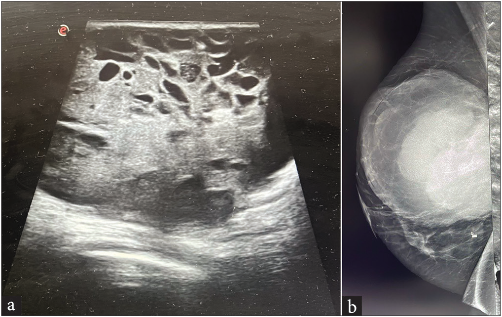 A 25-year-old female presented with a rapidly growing lump in the right breast associated with pain. (a) A grayscale ultrasound of the right breast shows a large, rounded, circumscribed, solid-cystic mass with associated posterior enhancement. (b) The CC view of the mammography shows a large rounded high-density lesion with circumscribed margins occupying all quadrants of the breast. CC: Cranio-caudal.