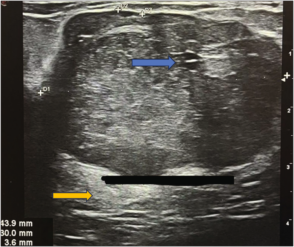 A 37-year-old female presented with a lump in her left breast for 5 years. A grayscale USG of the left breast shows a parallel-oriented oval-shaped lesion with circumscribed margins, heterogeneous echotexture, and posterior enhancement (yellow arrow). Small internal cystic spaces are seen (blue arrow).